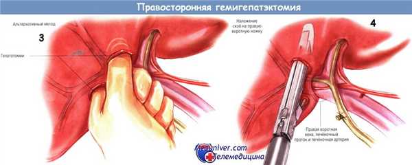 Ход операции правосторонней гемигепатэктомии