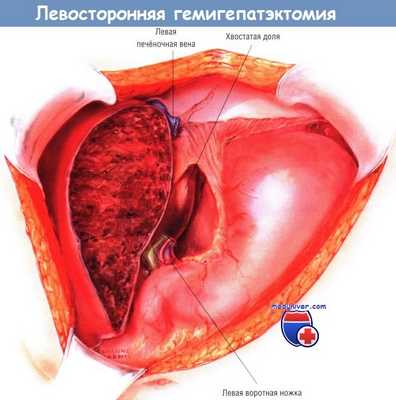 Ход операции левосторонней гемигепатэктомии