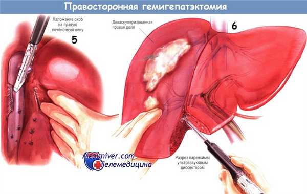 Ход операции правосторонней гемигепатэктомии