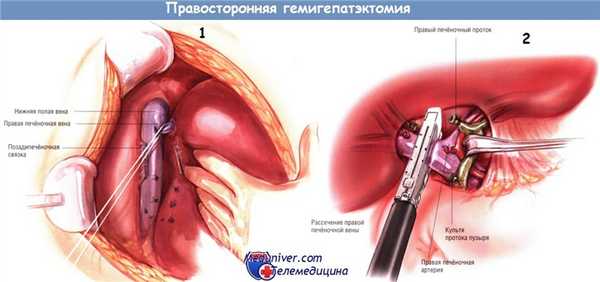 Ход операции правосторонней гемигепатэктомии