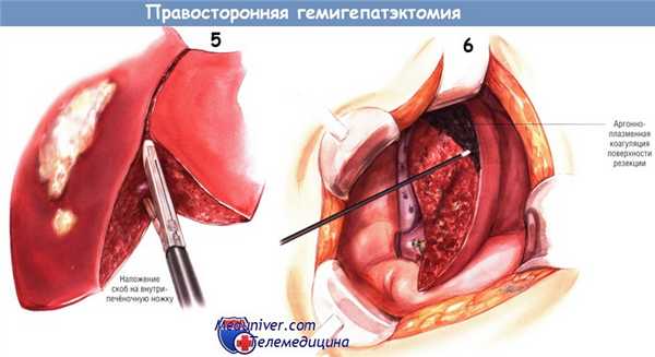 Ход операции правосторонней гемигепатэктомии
