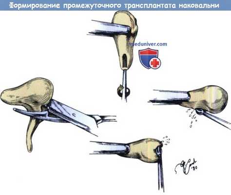 Формирование промежуточного трансплантата наковальни