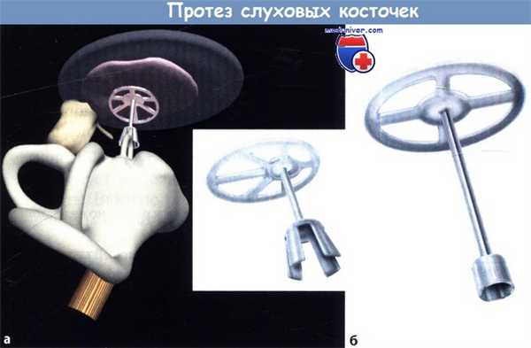Протез слуховых косточек уха