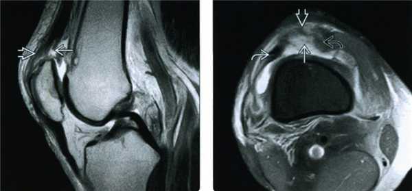 МРТ травмы четырехглавой мышцы