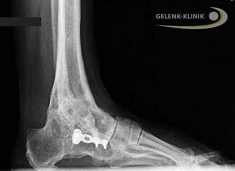 Артродез голеностопного сустава проводится и при использовании интрамедуллярных гвоздей, которые соединяют большеберцовую кость с таранной и пяточной. Артроз нижнего голеностопа и тяжелые травмы пяточной кости требуют проведения данной методики. Применение интрамедуллярных гвоздей для обездвиживания голеностопа приводит ещё и обездвиживанию сустава между пяточной и таранной костью. © Gelenk-Klinik