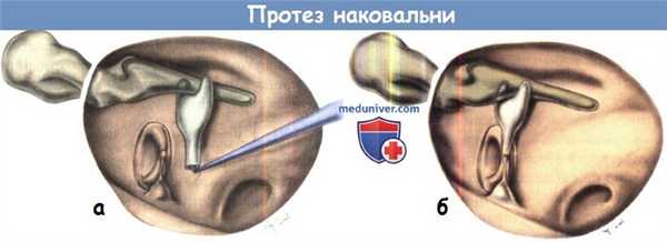 Протез наковальни