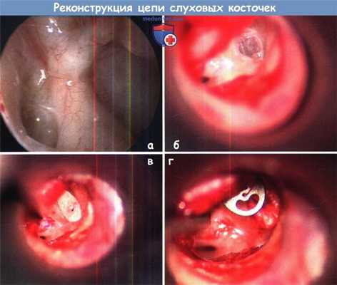 Реконструкция слуховых косточек
