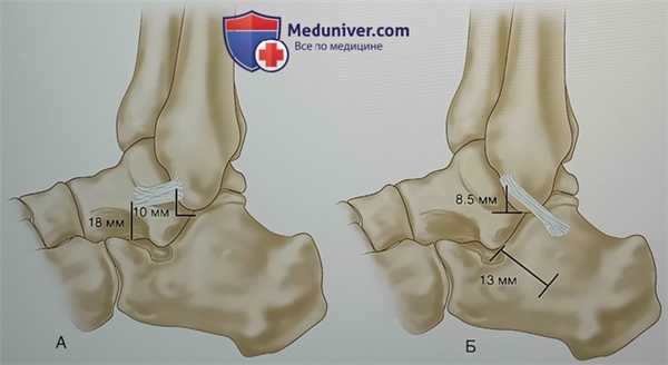 Операция реконструкции латеральных связок голеностопного сустава с использованием аутосухожилия подошвенной мышцы
