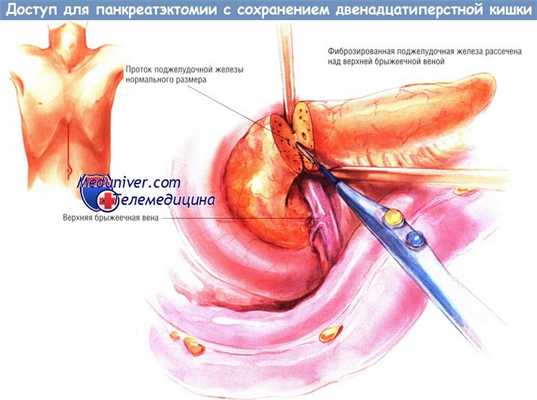 Доступ для панкреатэктомии с сохранением двенадцатиперстной кишки