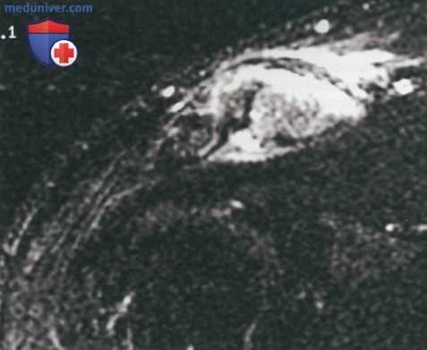 Артроскопическая резекция дистального конца ключицы