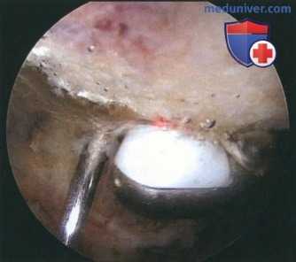 Артроскопическая резекция дистального конца ключицы