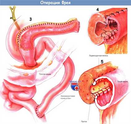 Методика операции Фрея