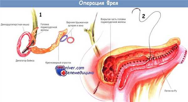 Методика операции Фрея