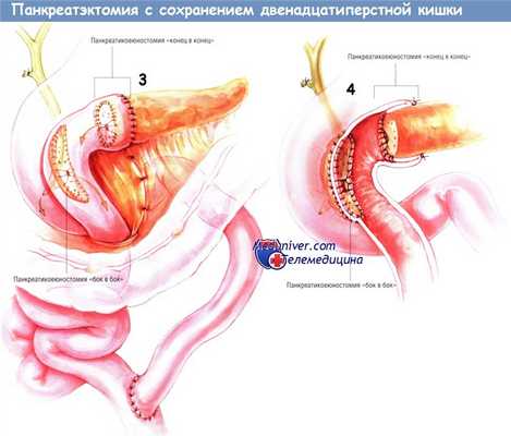Методика операции панкреатэктомии с сохранением двенадцатиперстной кишки