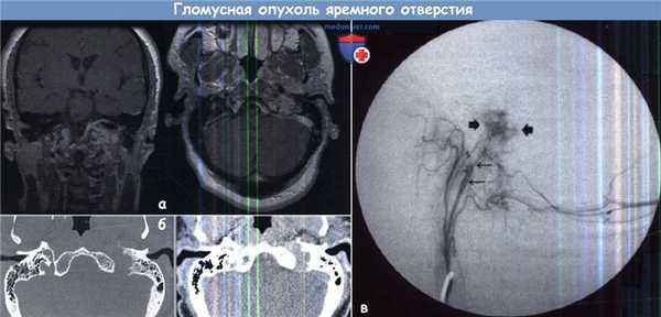 Гломусная опухоль яремного отверстия