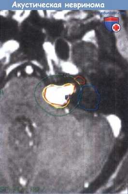 Акустическая невринома