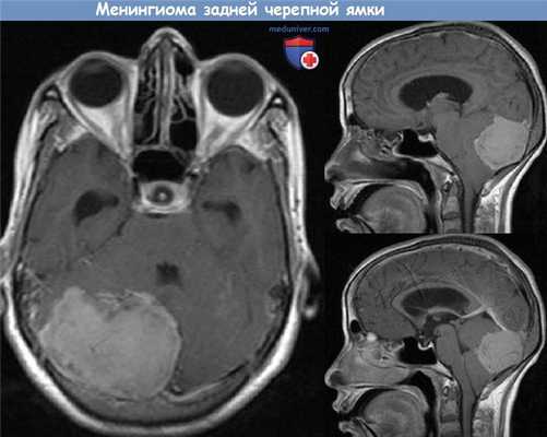 Менингиома задней черепной ямки