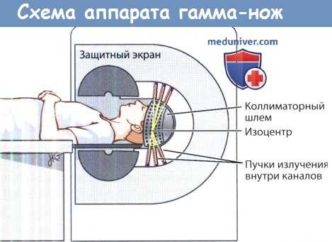 Схема аппарата гамма-нож
