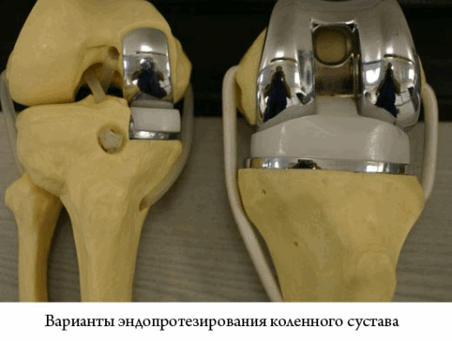 Варианты эндопротезирования коленного сустава