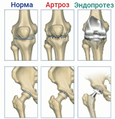 Эндопротезирование, норма, артроз и эндопротез