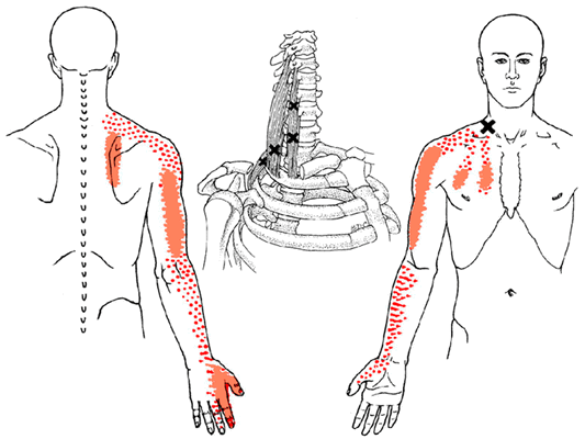 Миофасциальный синдром лестничной мышцы
