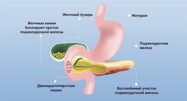 Причины острого панкреатита