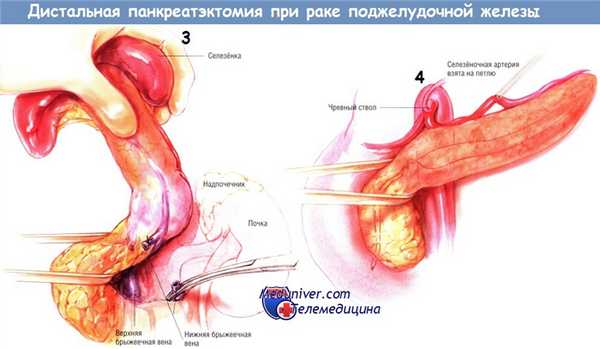 Методика операции дистальной панкреатэктомии при раке поджелудочной железы