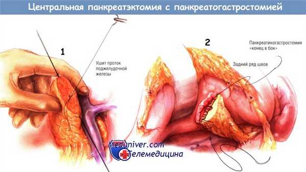Методика центральной панкреатэктомии с панкреатикогастростомией