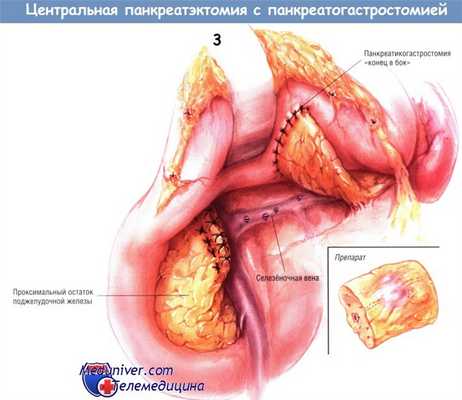 Методика центральной панкреатэктомии с панкреатикогастростомией