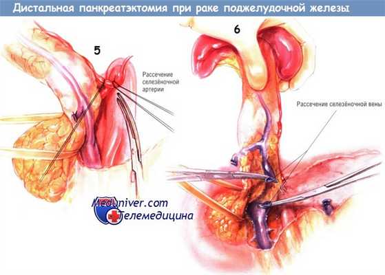 Методика операции дистальной панкреатэктомии при раке поджелудочной железы