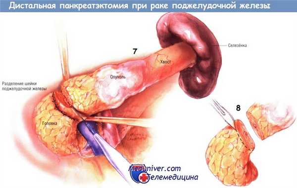 Методика операции дистальной панкреатэктомии при раке поджелудочной железы