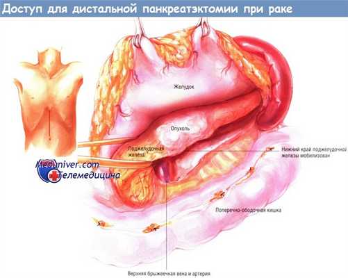 Доступ для дистальной панкреатэктомии при раке поджелудочной железы