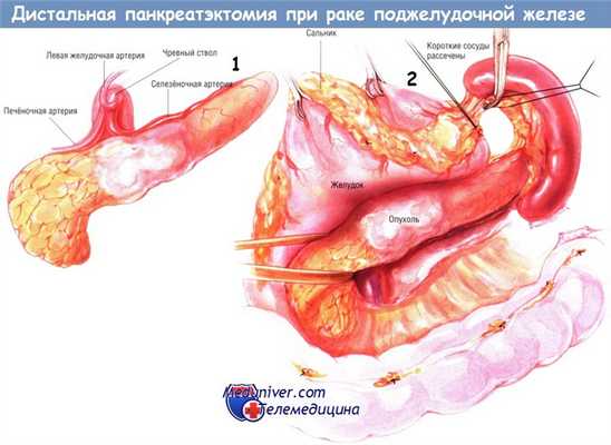Методика операции дистальной панкреатэктомии при раке поджелудочной железы