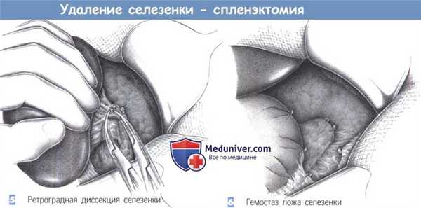 Этапы и техника удаления селезенки (спленэктомии)