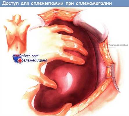 Доступ для спленэктомии при спленомегалии