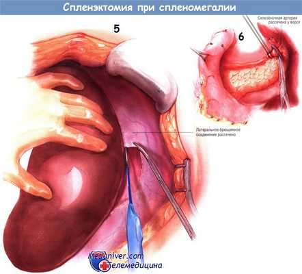 Методика спленэктомии при спленомегалии
