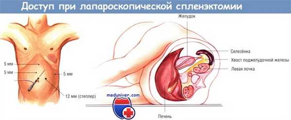 Доступ для лапароскопической спленэктомии