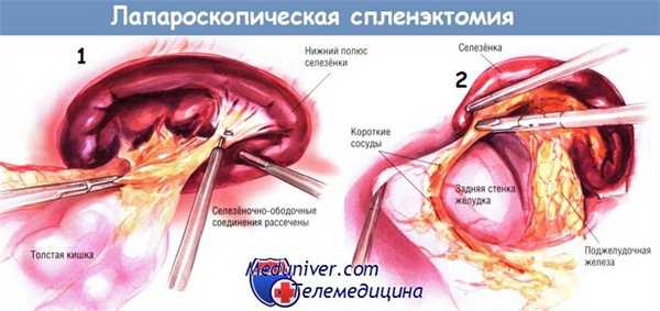 Методика лапароскопической спленэктомии
