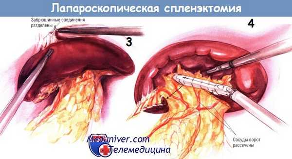 Методика лапароскопической спленэктомии