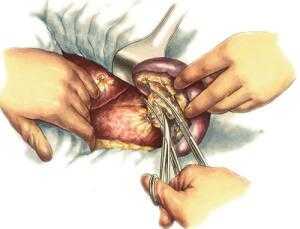 Спленэктомия