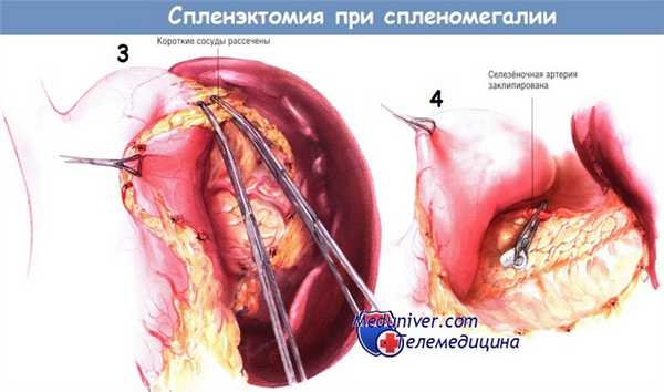 Методика спленэктомии при спленомегалии