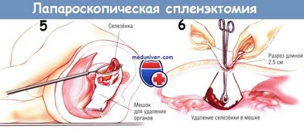 Методика лапароскопической спленэктомии