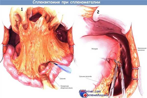 Методика спленэктомии при спленомегалии