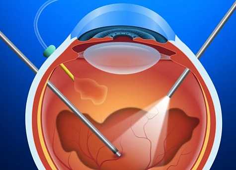 Витреоретинальная хирургия в Москве