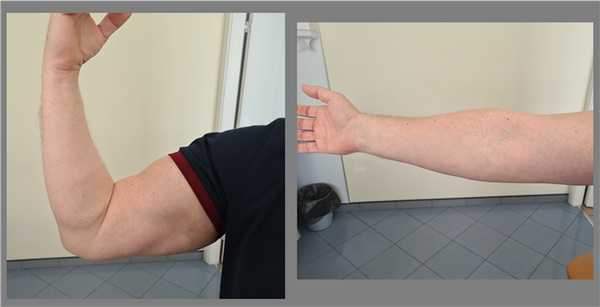 разрыв бицепса реабилитация