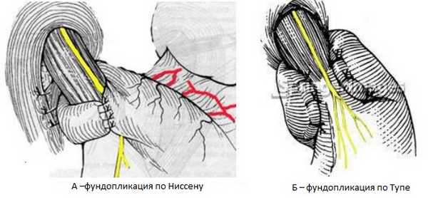 ниссен тупе