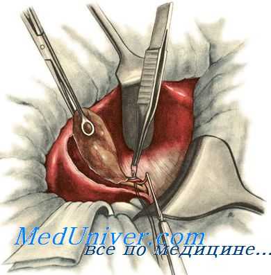 Хирургическое лечение острого холецистита. Экстренная холецистэктомия