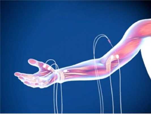 проведение электромиографии