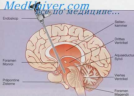 спинальные операции в нейрохирургии