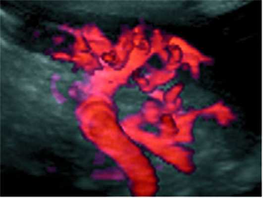 Разрыв селезенки